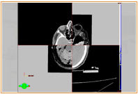 traitement radiothérapie 3D
