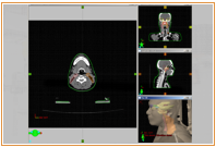 traitement radiothérapie 3D