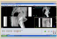 traitement radiothérapie 3D