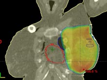 volume cible  Cancer du Sein