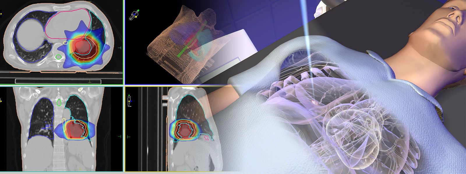 La radiothérapie - le traitement